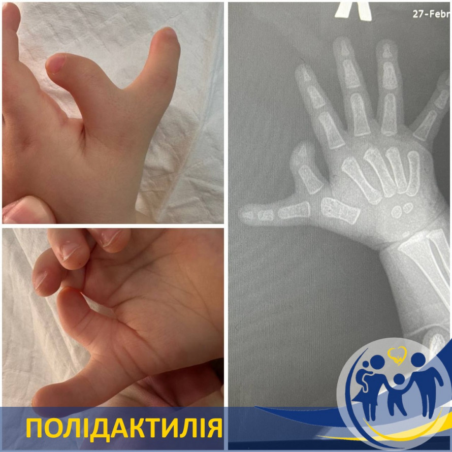 Прибрали вроджену ваду - у Запоріжжі лікарі провели ювелірну операцію на кисті дитини (фото)